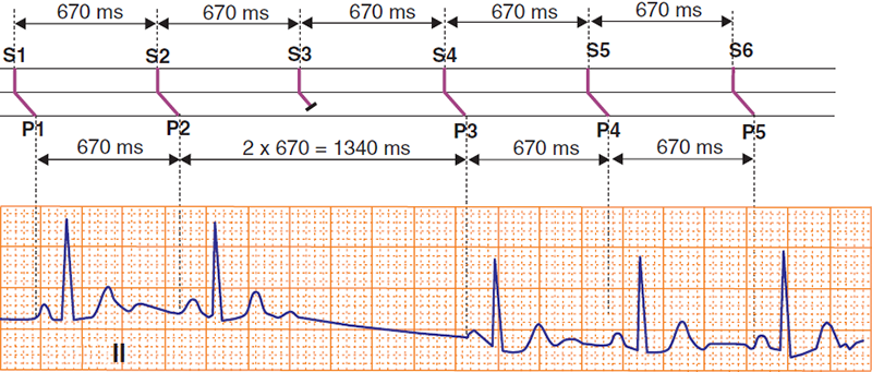 ECG and laddergram, 2nd degree sinoatrial (SA) block, SA exit block, PP interval with pause