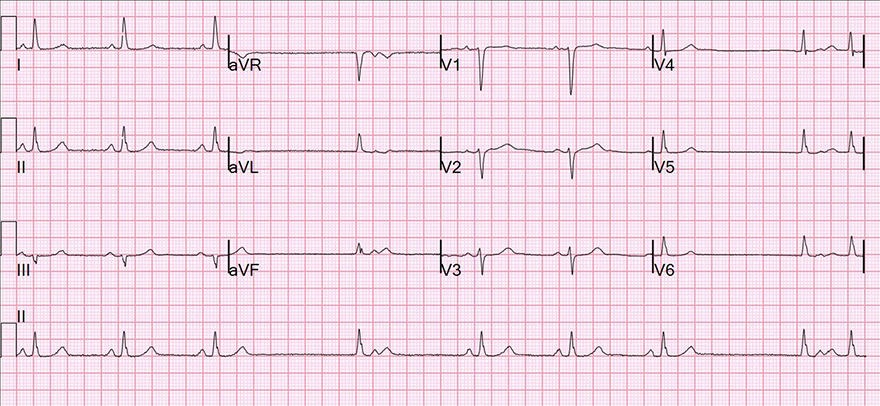 12 leads ECG, second degree SA block, type 2, premature junctional complex