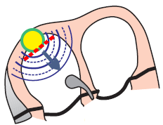 sinoatrial exit block 