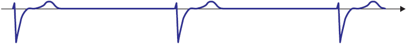 ECG 3rd degree sa block, junctional rhythm