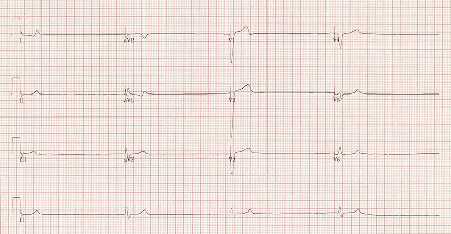 ECG 3rd detree sinoatrial (SA) block and ventricular escape rhythm