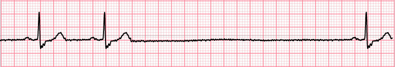 ECG 3rd degree sa block, pp pause