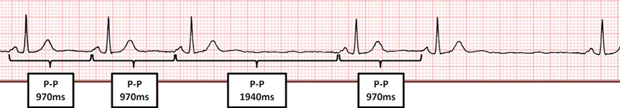 ECG second degree sinoatrial SA block, type 2