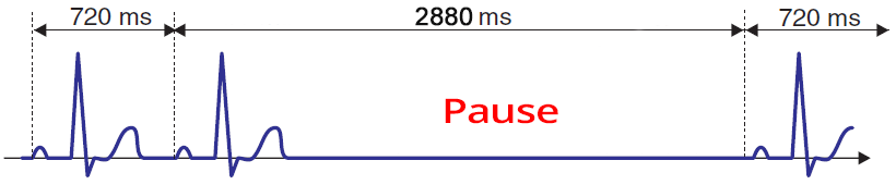 ECG 3rd degree complete sa block, PP pause