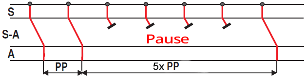 Laddergram, sa node, sa junction, atria, 3rd degree sa block, pp pause