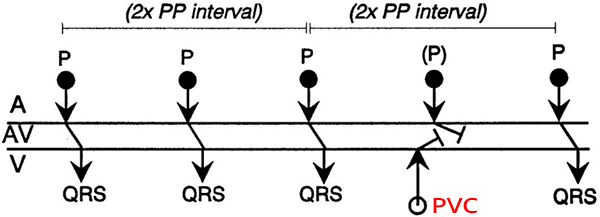 Fully compensatory pause, following a ventricular premature complex