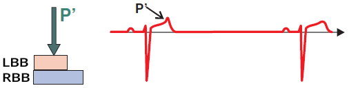 ECG premature atrial complex, block pac in refractory period