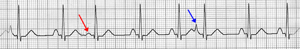 ECG multifocal premature atrial complex, multiple P waves morphologies