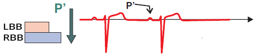 ECG prematura atrial complex conduction, and narrow QRS complex