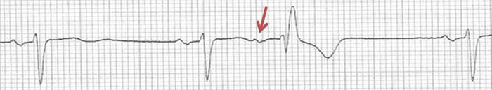 ECG premature atrial complex aberrant conduction, rbbb