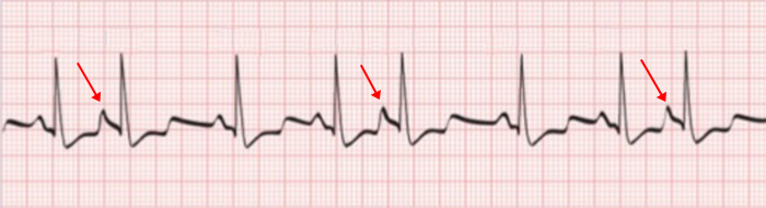 ECG trigeminy premature atrial complex