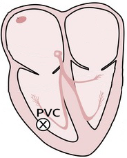 ventricular ectopic, and premature ventricular complex