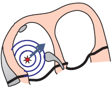 Ectopic atrial focus