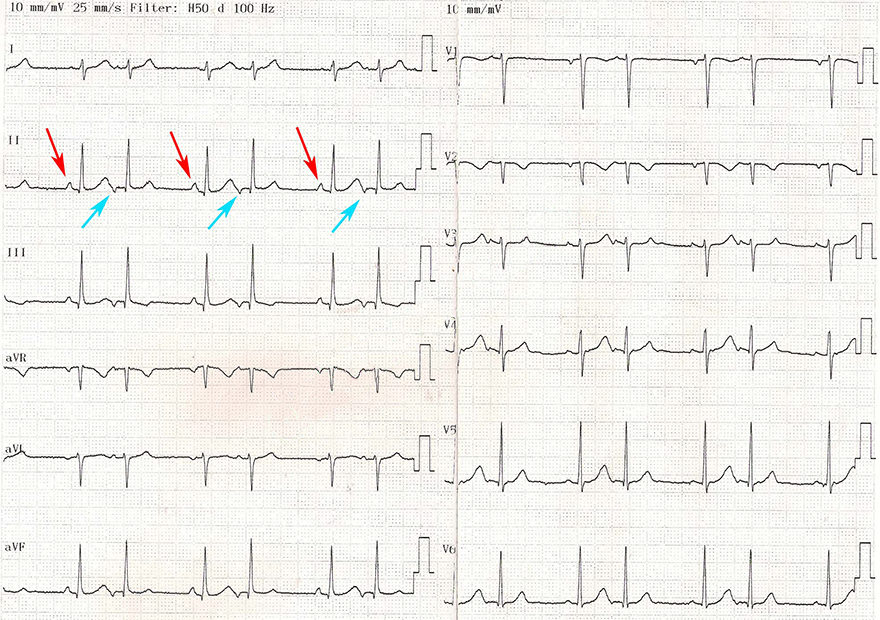 ECG atrial bigeminy rhythm, ectopic focus and SA node depolarisation