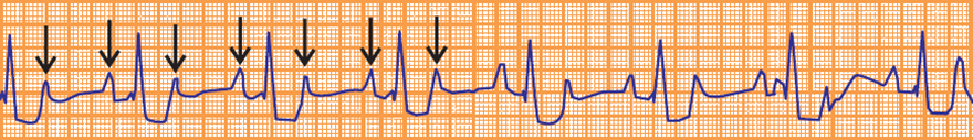 ECG unifocal atrial tachycardia, fixed AV block 2:1