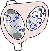 Atrial fibrillation, multifocal re-entry