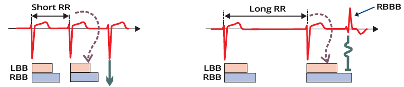 Atrial fibrillation Ashman phenomenon, long refractory period, RR interval, aberrantly conducted beat RBBB morphology