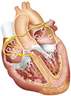 Heart with atrial fibrillation