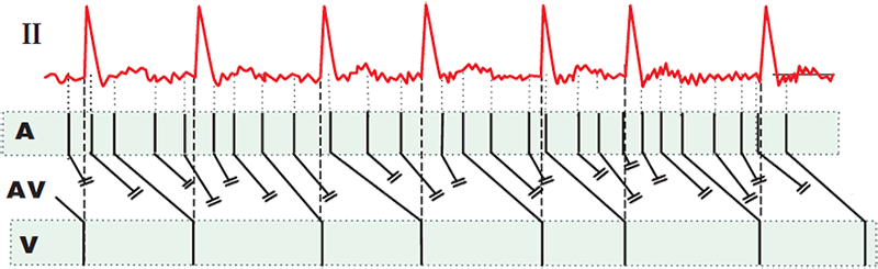 ECG, laddergram concealed conduction and atrial fibrillation