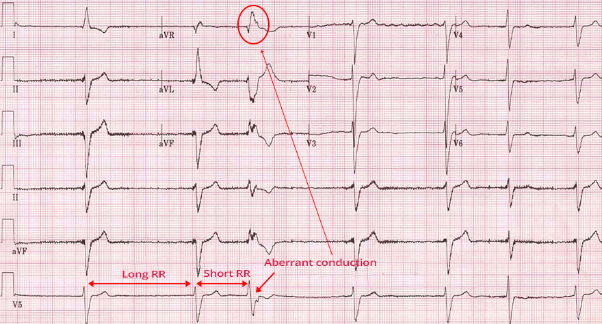 ECG ashman phenomenon, atrial fibrillation, aberrant conduction, RBBB