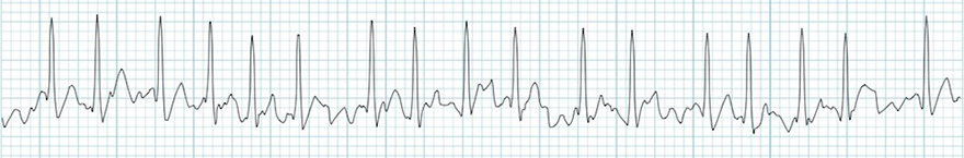 ECG coarse atrial fibrillation, irregularly irregular rhythm, no P waves, narrow QRS