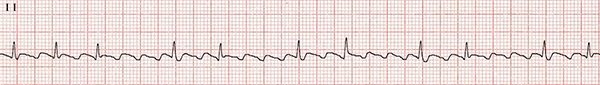 ECG atrial flutter, conduction ratio 2:1, 4:1