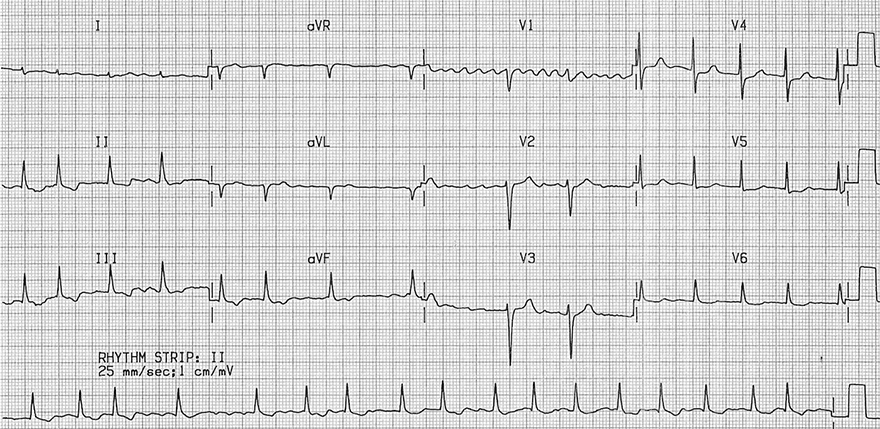 ECG coarse atrial fibrillation, irregular ventricular response