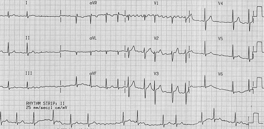 ECG coarse atrial fibrillation, irregular narrow-complex, coarse fibrillatory waves