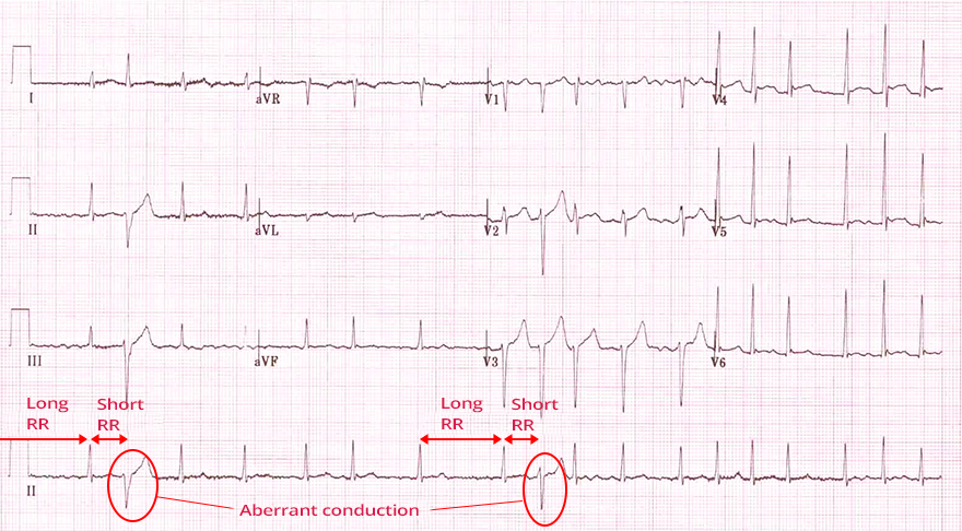 Atrial Fibrillation - ECG book