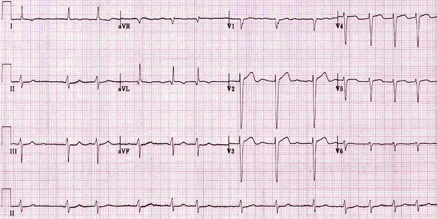 ECG fine atrial fibrillation, fine fibrillatory waves seen in V1, irregular ventricular response