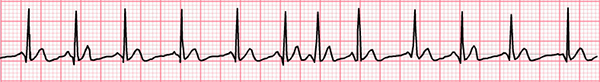 ECG multifocal atrial tachycardia, enhanced automaticity