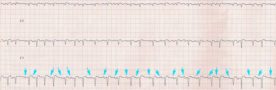 ECG multifocal atrial tachycardia, irreguler rhythm, constant PR interval