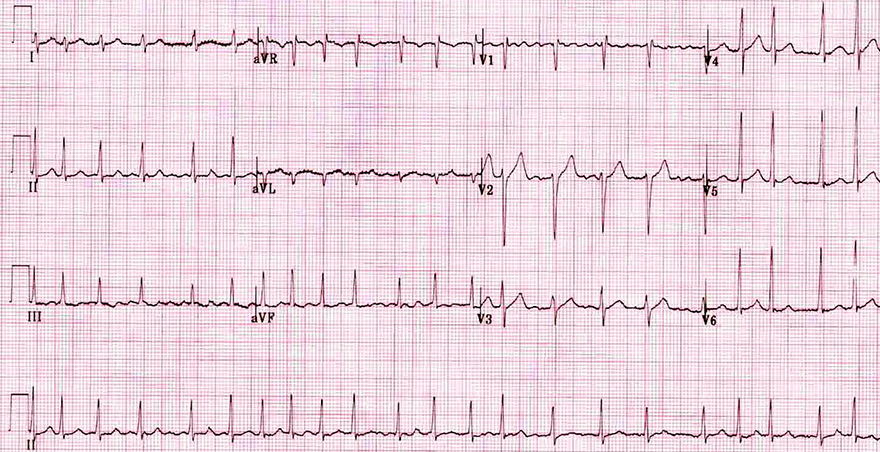 ECG coarse atrial fibrillation, rapid ventricular response, irregular narrow-complex tachycardia