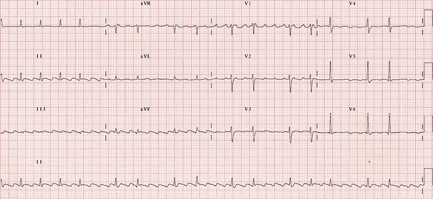 ECG typical atrial flutter, ratio 2:1, 4:1, variable AV block