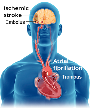 Thromboembolic ischemic stroke, atrial fibrillation, left atrial appendage with thrombus formation