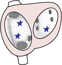 Multifocal atrial tachycardia mechanism