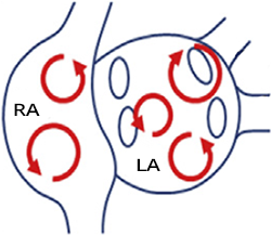 Atrial fibrillation, multiple wavelet mechanism, multiple micro re-entry