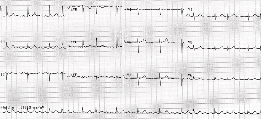 ECG isthmus dependent clockwise Reentry atrial flutter, variable block 2:1, 4:1