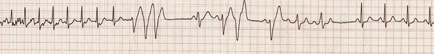 ECG supraventricular tachycardia, AVNRT reverts to sinus rhythm after an adenosine bolus