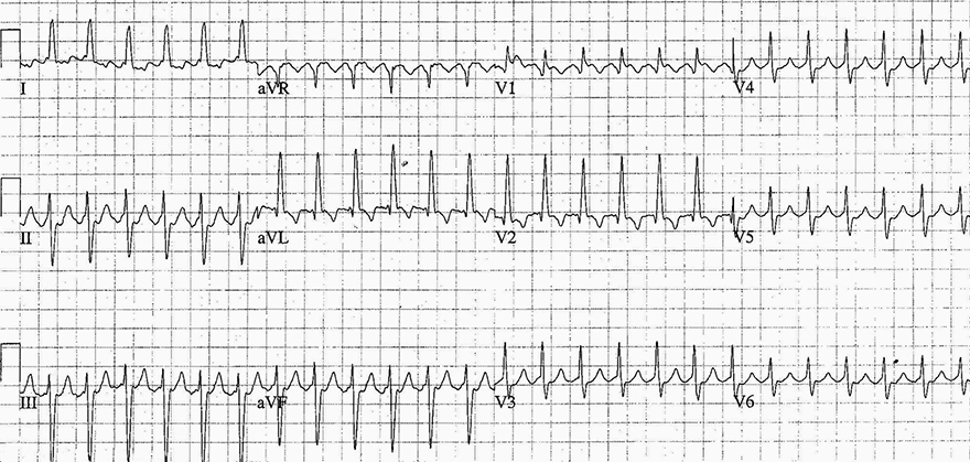 ECG supraventricular tachycardia, Clockwise reentry atrial flutter, with flutter waves