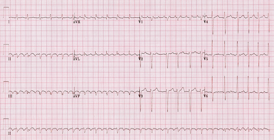 ECG, Atrial Flutter with 2:1 Block (anticlockwise flutter), inverted flutter waves (II, III, aVF), flutter waves in V1