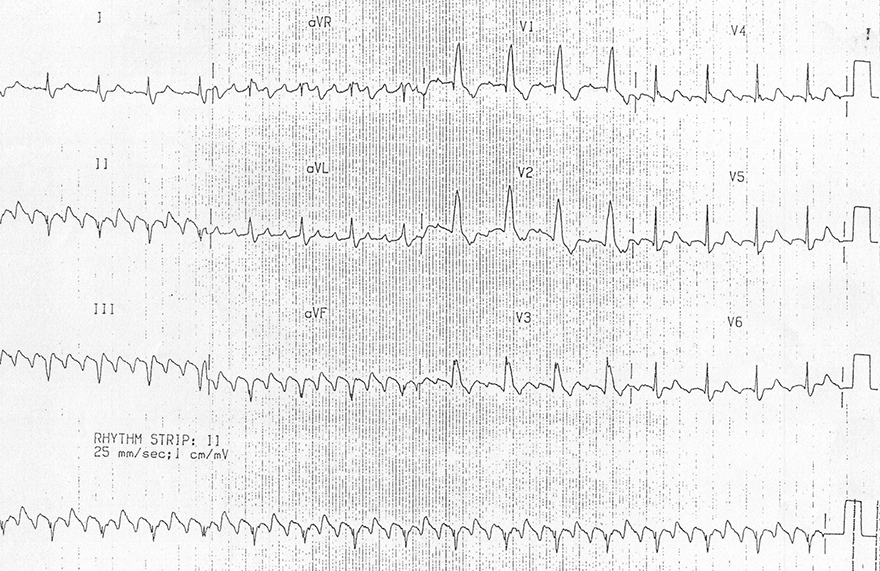 ECG Typical Atrial Flutter (AV block 3:1), Common, Type I (Anticlockwise Reentry), negative flutter waves in the inferior leads (II, III), atrial rate 300bpm, ventricular rate 100bpm