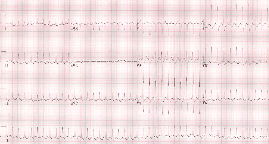 ECG rapid narrow complex tachycardia, AVRT ? ANRT ? atrial flutter with 1:1 AV block