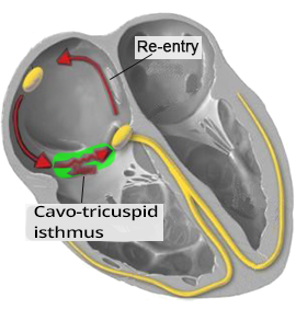 Typical Atrial Flutter (Common, or Type I Atrial Flutter)