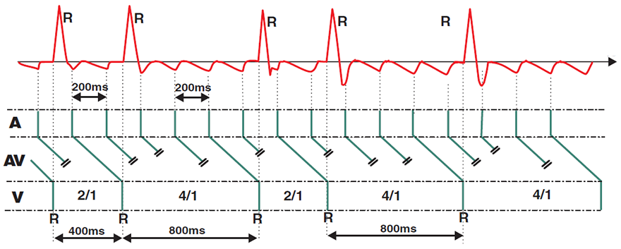 Laddergram typical atrial flutter, variable block 2:1, 4:1