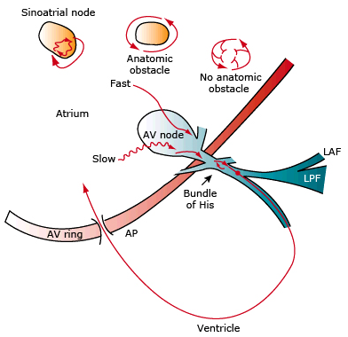 supraventricular arrhythmias, re-entry mechanism