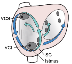 Typical common atrial flutter, type I, Anticlockwise atrial flutter