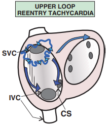 Atypical atrial flutter, Upper loop reentry tachycardia