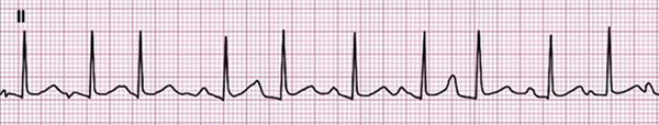 ECG multifocal atrial tachycardia