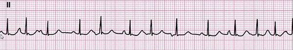 ECG multifocal atrial tachycardia